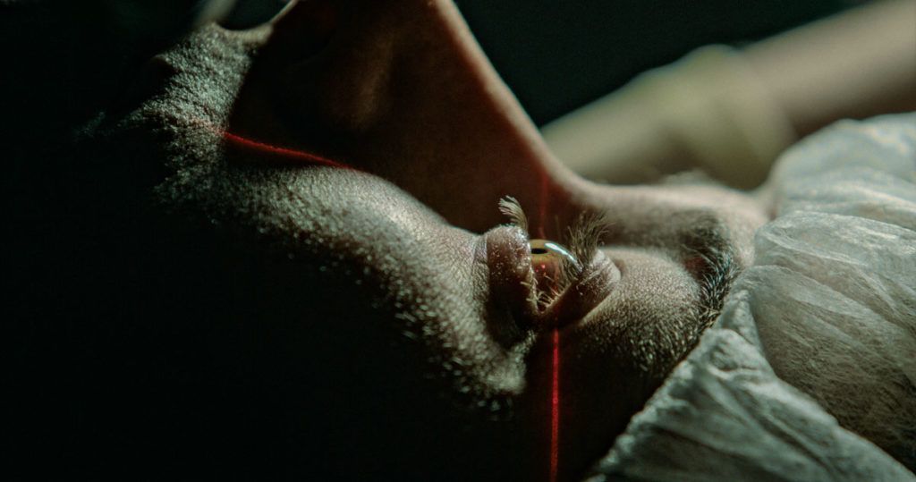 Refractive Lens Exchange